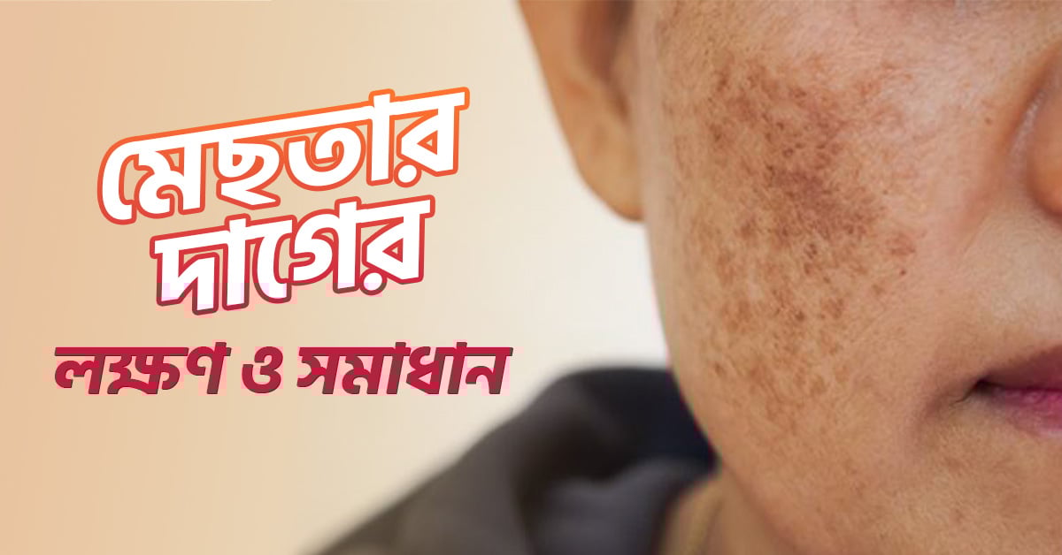 মেলাজমা হওয়ার কারণ, প্রতিরোধ ও চিকিৎসা