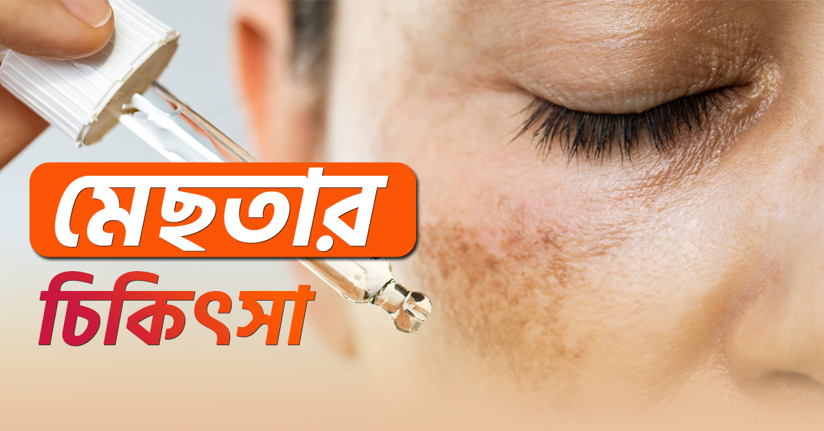মেলাজমার চিকিৎসা
